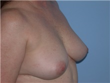 Breast Augmentation Before Photo by Gerard Mosiello, MD; Tampa, FL - Case 23626