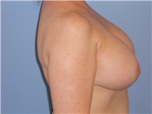 Breast Augmentation After Photo by Gerard Mosiello, MD; Tampa, FL - Case 23626