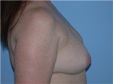 Breast Augmentation Before Photo by Gerard Mosiello, MD; Tampa, FL - Case 23626