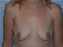 Breast Augmentation Before Photo by Gerard Mosiello, MD; Tampa, FL - Case 8311