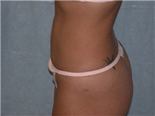 Liposuction After Photo by Gerard Mosiello, MD; Tampa, FL - Case 8316