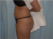 Liposuction Before Photo by Gerard Mosiello, MD; Tampa, FL - Case 8316