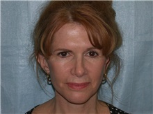 Facelift After Photo by Gerard Mosiello, MD; ,  - Case 8353