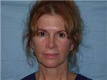 Facelift Before Photo by Gerard Mosiello, MD; ,  - Case 8353