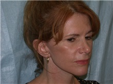 Facelift After Photo by Gerard Mosiello, MD; ,  - Case 8353