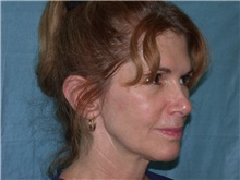 Facelift Before Photo by Gerard Mosiello, MD; ,  - Case 8353