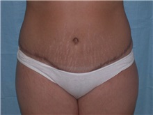Tummy Tuck After Photo by Gerard Mosiello, MD; Tampa, FL - Case 8524