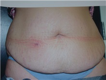 Tummy Tuck Before Photo by Gerard Mosiello, MD; Tampa, FL - Case 8524