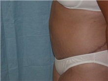 Tummy Tuck After Photo by Gerard Mosiello, MD; Tampa, FL - Case 8524