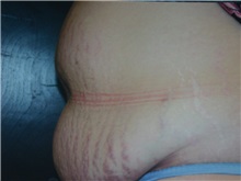 Tummy Tuck Before Photo by Gerard Mosiello, MD; Tampa, FL - Case 8524