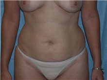 Liposuction Before Photo by Gerard Mosiello, MD; Tampa, FL - Case 9024