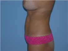 Liposuction After Photo by Gerard Mosiello, MD; Tampa, FL - Case 9024