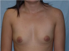 Breast Augmentation Before Photo by Gerard Mosiello, MD; Tampa, FL - Case 9798