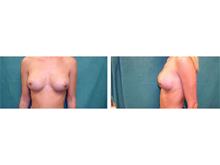Breast Augmentation After Photo by Rigo Mendoza, MD; Tampa, FL - Case 29268