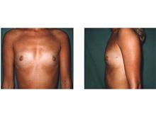 Breast Augmentation Before Photo by Rigo Mendoza, MD; Tampa, FL - Case 29268