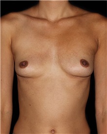Breast Implant Removal After Photo by Michael Schwartz, MD; Westlake Village, CA - Case 37230