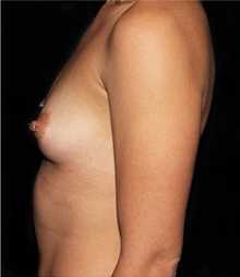 Breast Augmentation Before Photo by Michael Schwartz, MD; Westlake Village, CA - Case 37231