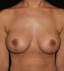 Breast Lift After Photo by Michael Schwartz, MD; Westlake Village, CA - Case 37237