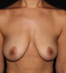 Breast Lift Before Photo by Michael Schwartz, MD; Westlake Village, CA - Case 37237