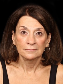 Facelift After Photo by Michael Schwartz, MD; Westlake Village, CA - Case 38285