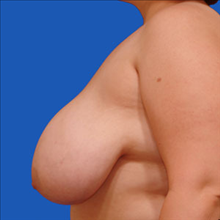 Breast Reduction Before Photo by Joseph Cruise, MD; Newport Beach, CA - Case 24697