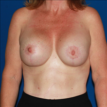 Breast Reconstruction After Photo by Joseph Cruise, MD; Newport Beach, CA - Case 24698