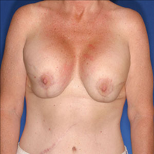 Breast Reconstruction Before Photo by Joseph Cruise, MD; Newport Beach, CA - Case 24698