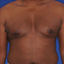 Male Breast Reduction After Photo by Joseph Cruise, MD; Newport Beach, CA - Case 24699