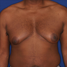 Male Breast Reduction Before Photo by Joseph Cruise, MD; Newport Beach, CA - Case 24699