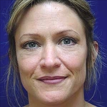Eyelid Surgery After Photo by Joseph Cruise, MD; Newport Beach, CA - Case 24701