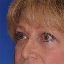 Eyelid Surgery After Photo by Joseph Cruise, MD; Newport Beach, CA - Case 24702