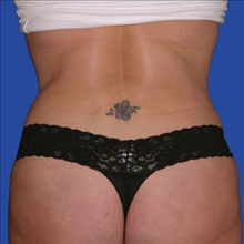 Liposuction After Photo by Joseph Cruise, MD; Newport Beach, CA - Case 24704