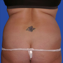 Liposuction Before Photo by Joseph Cruise, MD; Newport Beach, CA - Case 24704