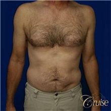 Male Breast Reduction After Photo by Joseph Cruise, MD; Newport Beach, CA - Case 37403