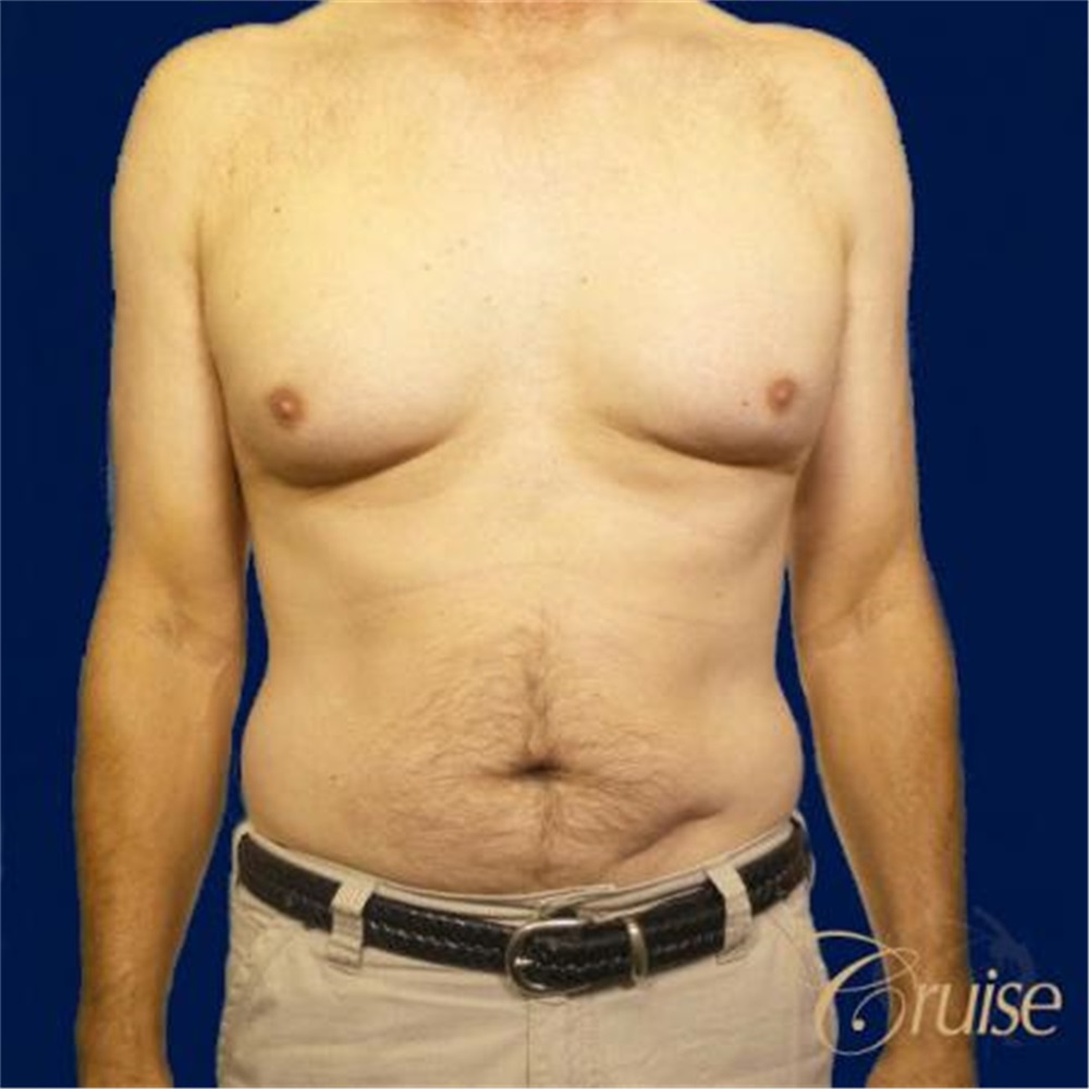 Breast Reduction DD to C Cup Before & After Photos, Newport Beach,  California (CA), Joseph T. Cruise, M.D., Board Certified Plastic Surgeons