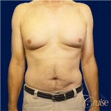 Male Breast Reduction Before Photo by Joseph Cruise, MD; Newport Beach, CA - Case 37403