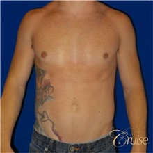 Male Breast Reduction After Photo by Joseph Cruise, MD; Newport Beach, CA - Case 37404