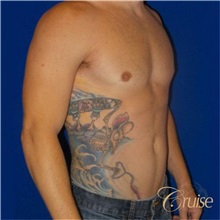 Male Breast Reduction After Photo by Joseph Cruise, MD; Newport Beach, CA - Case 37404