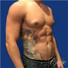 Male Breast Reduction Before Photo by Joseph Cruise, MD; Newport Beach, CA - Case 37404