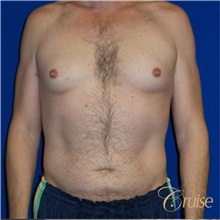 Male Breast Reduction Before Photo by Joseph Cruise, MD; Newport Beach, CA - Case 37405