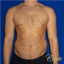 Male Breast Reduction After Photo by Joseph Cruise, MD; Newport Beach, CA - Case 37407