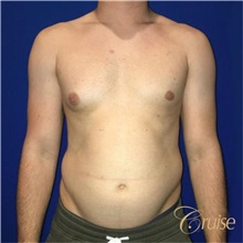 Male Breast Reduction Before Photo by Joseph Cruise, MD; Newport Beach, CA - Case 37407