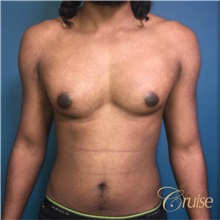 Male Breast Reduction Before Photo by Joseph Cruise, MD; Newport Beach, CA - Case 37410
