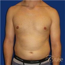Male Breast Reduction After Photo by Joseph Cruise, MD; Newport Beach, CA - Case 37411