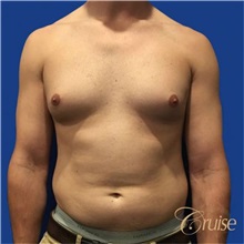 Male Breast Reduction Before Photo by Joseph Cruise, MD; Newport Beach, CA - Case 37411