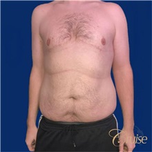 Male Breast Reduction After Photo by Joseph Cruise, MD; Newport Beach, CA - Case 37412