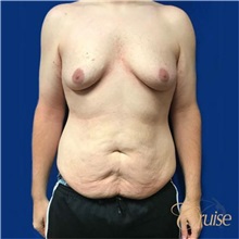 Male Breast Reduction Before Photo by Joseph Cruise, MD; Newport Beach, CA - Case 37412