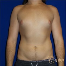 Male Breast Reduction Before Photo by Joseph Cruise, MD; Newport Beach, CA - Case 37413
