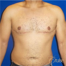 Male Breast Reduction After Photo by Joseph Cruise, MD; Newport Beach, CA - Case 37414