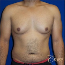 Male Breast Reduction Before Photo by Joseph Cruise, MD; Newport Beach, CA - Case 37414